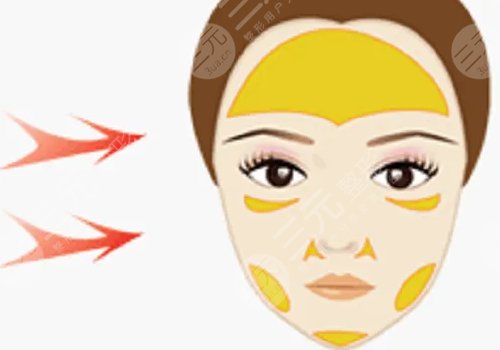 电波拉皮多少钱做一次?