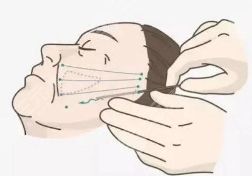 电波拉皮的功效与作用专业回答