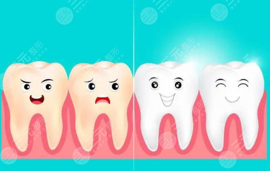 冷光美白牙齿的注意事项