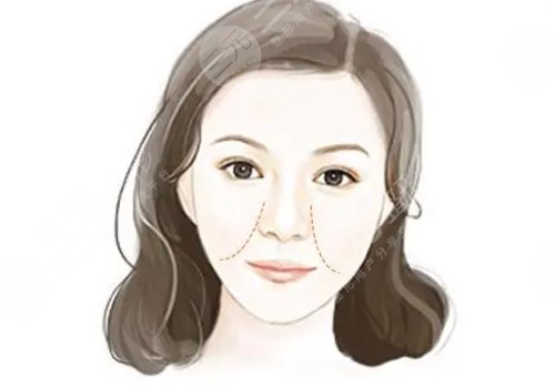 用什么填充法令纹好?
