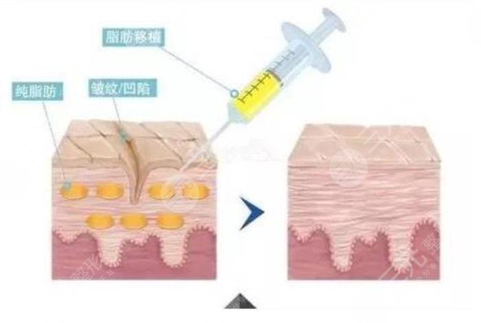 自体脂肪填充