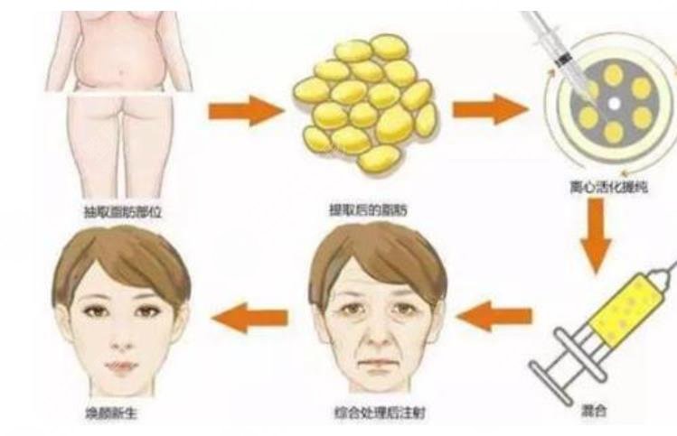 自体脂肪填充