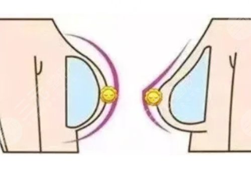 水滴形假体和圆形假体哪个更好看?