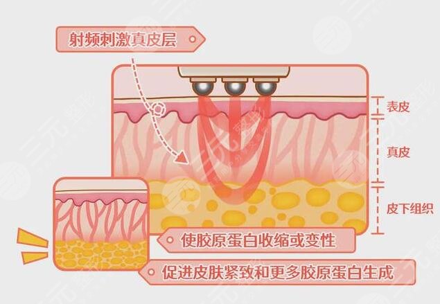 电波拉皮除皱的操作原理以及作用