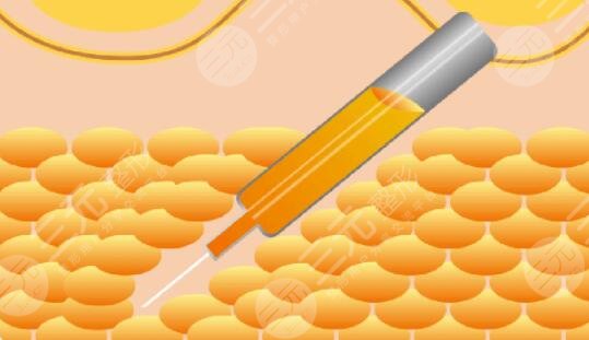 武汉亚太程晓林案例吸脂体验