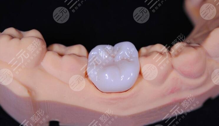 劲松口腔根管缓解案例