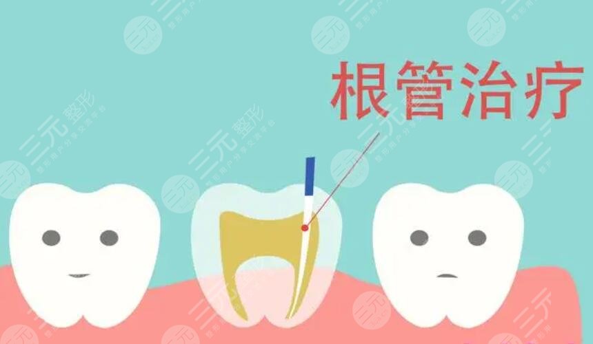 劲松口腔根管缓解案例