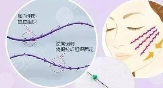线雕