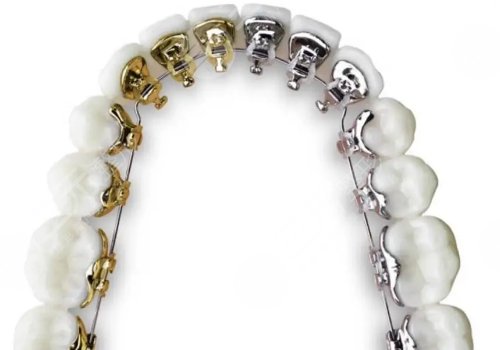 牙齿矫正多少钱价格表2023