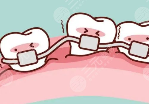 牙齿矫正多少钱价格表2023