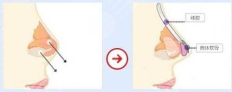 整鼻子用肋骨好还是耳软骨好?