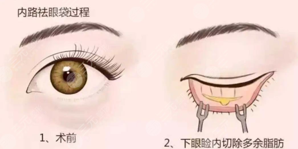 内切眼袋加眶隔释放恢复期