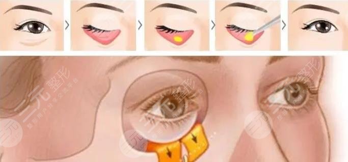 内切眼袋加眶隔释放恢复期