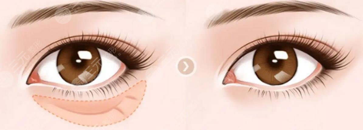 内切眼袋加眶隔释放恢复期