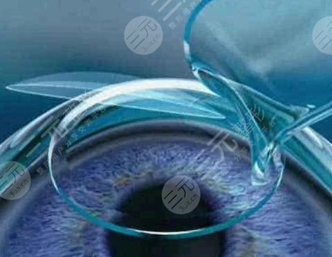 晶体植入近视手术的利与弊