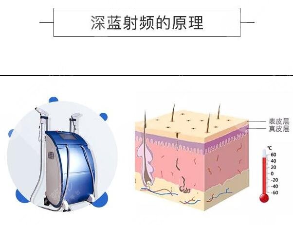 深蓝射频原理是什么?