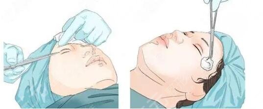 范希玲医生扇形双眼皮案例分享