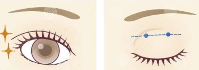 范希玲医生扇形双眼皮案例分享