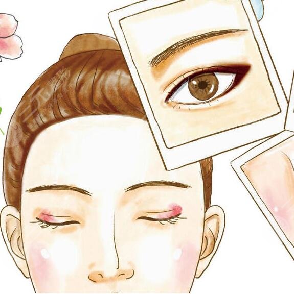 范希玲医生扇形双眼皮案例分享