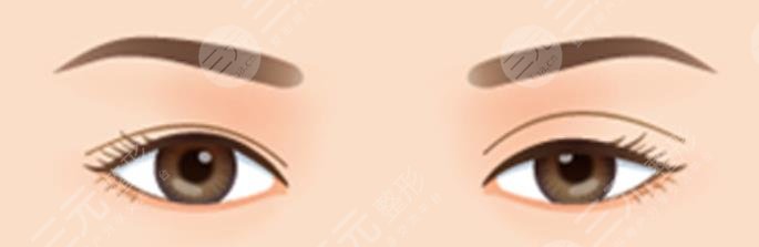 双眼皮