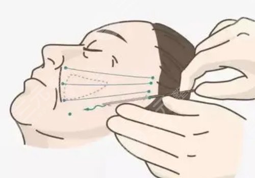 电波拉皮的危害和副作用有哪些?