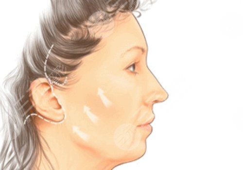 电波拉皮的危害和副作用有哪些?