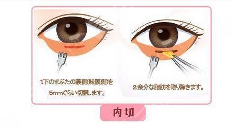 内切眼袋能保持几年