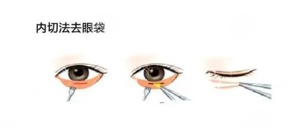 内切眼袋能保持几年