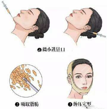 脸部吸脂肪大概需要多少钱？价格表公开！3家正规医院介绍~