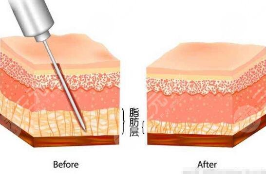 男士乳房肥大吸脂手术费用多少?价格标准公开!术前科普~