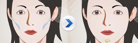 面部填充大概费用?