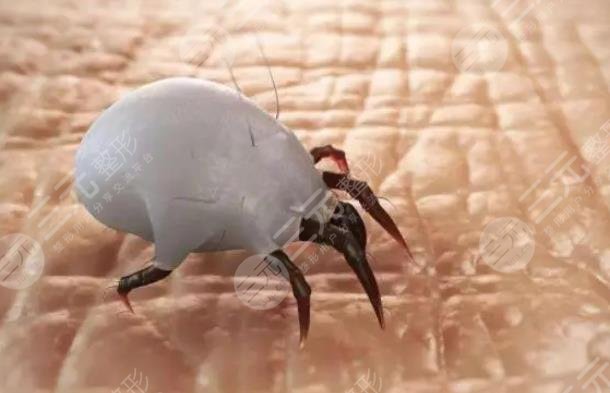 螨虫感染皮肤的症状