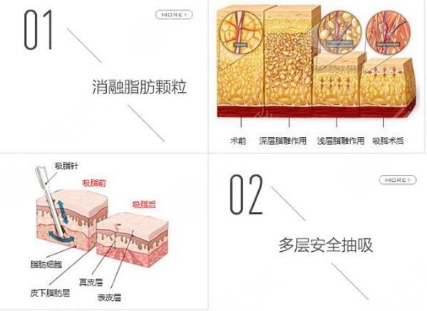 男人胸部吸脂多少钱？手术费用价格表分享！术前必看指南~