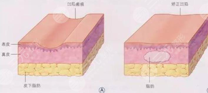 面部填充