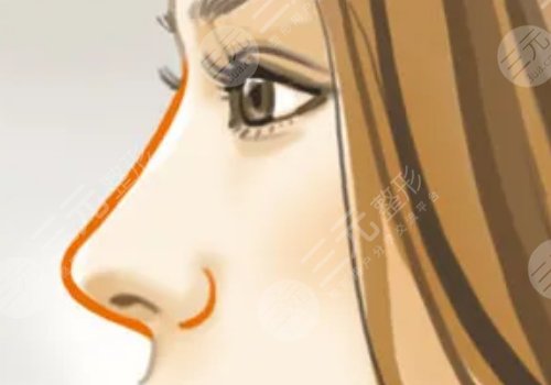 美国菲斯挺膨体适合放在鼻子哪里?