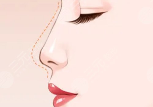 美国菲斯挺膨体适合放在鼻子哪里?