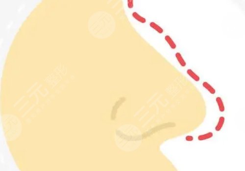 打玻尿酸隆鼻子有副作用吗？