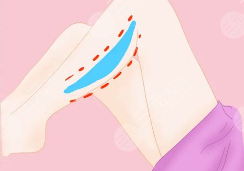 以色列飞顿5g吸脂有假的吗?