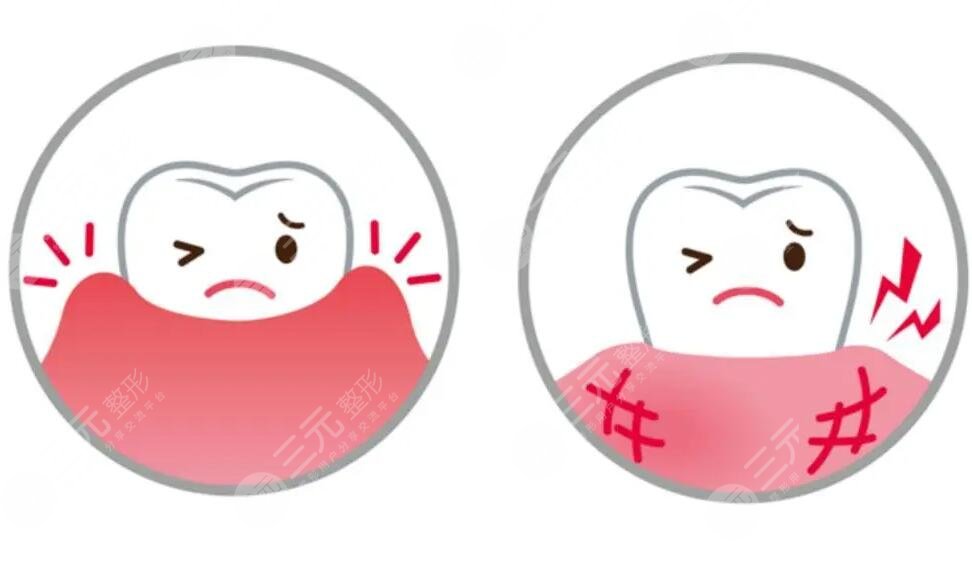 牙龈肿痛如何快速消肿止痛?