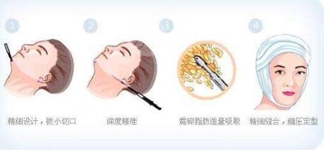 宋延刚医生面吸案例分享