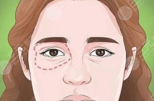 内切眼袋多久可以戴隐形眼镜