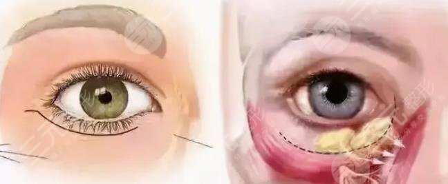 外切眼袋恢复过程图