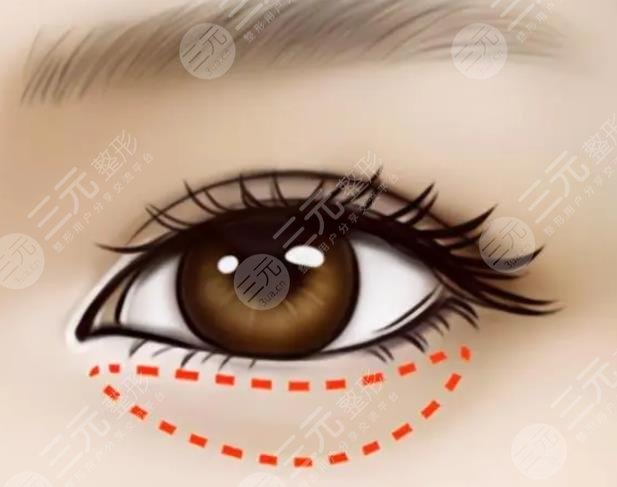 外切眼袋恢复过程图