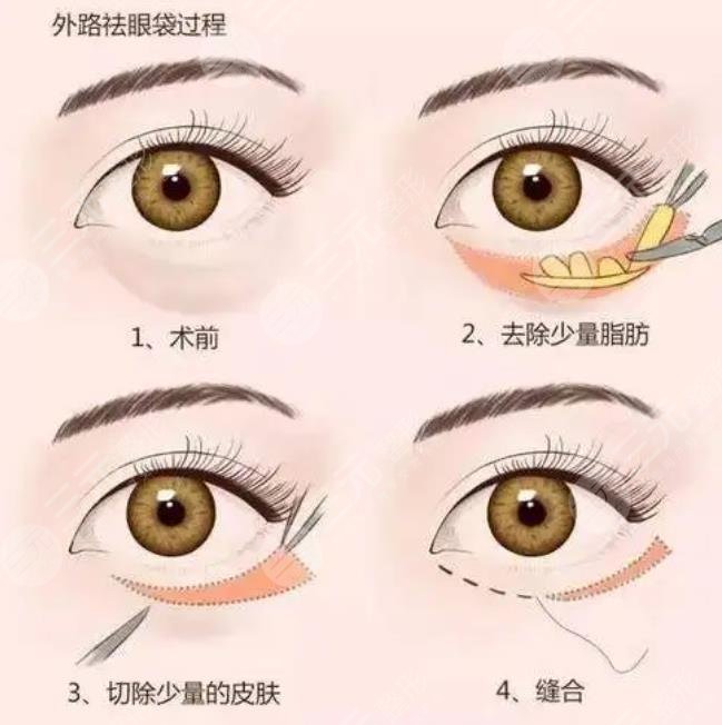 外切眼袋恢复过程图