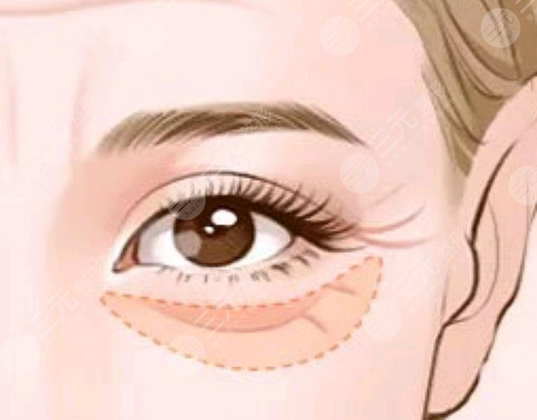 外切眼袋恢复过程图