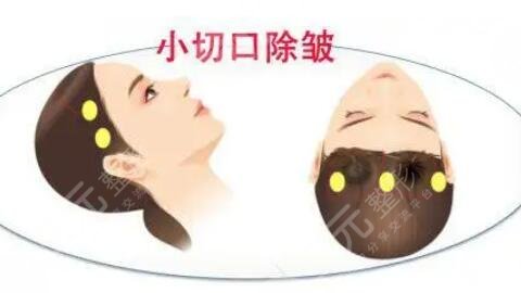 小切口除皱