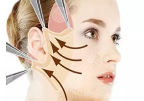 筋膜复位术能保持多久?