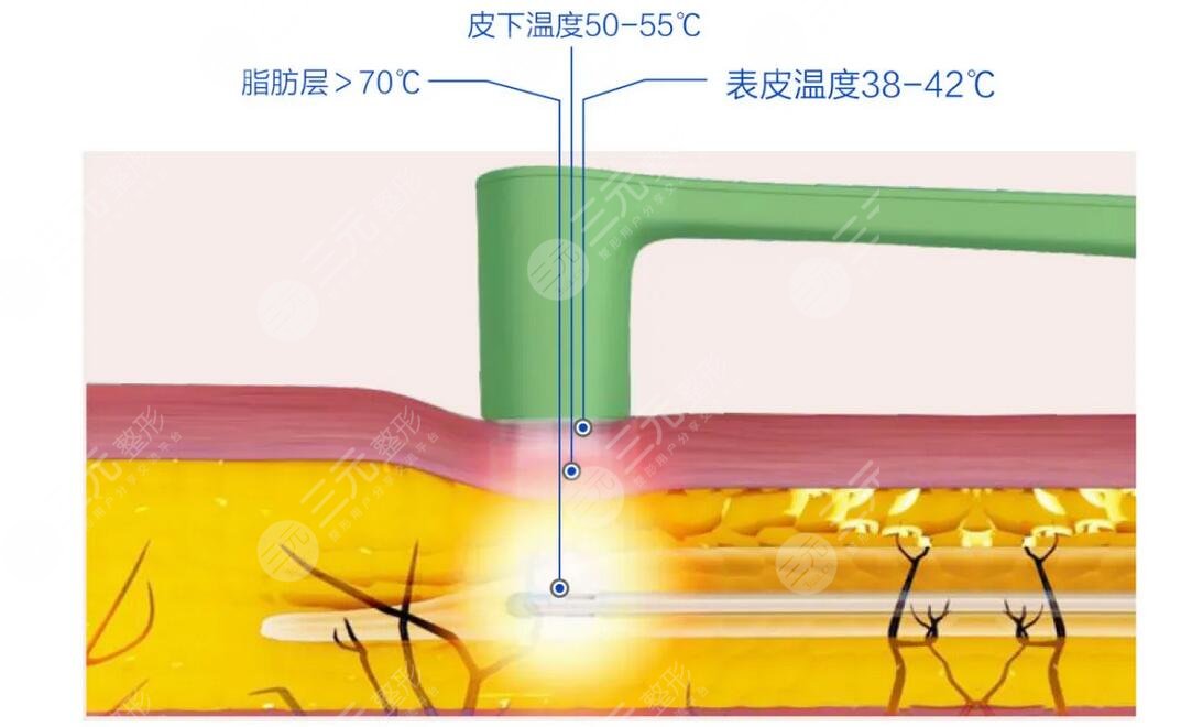 美迪迈黄金微针和半岛区别