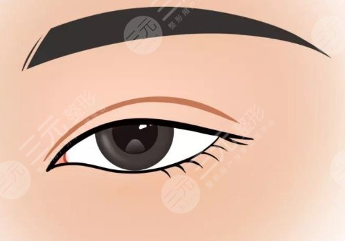 割双眼皮手术多少钱？