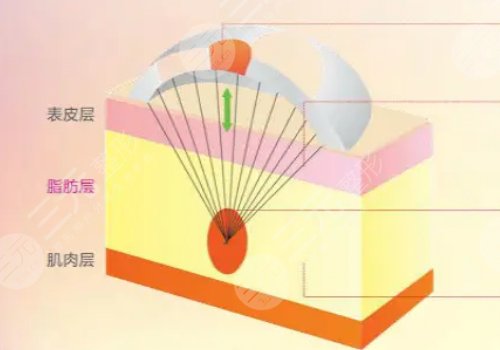 电波拉皮和热玛吉的区别在哪?